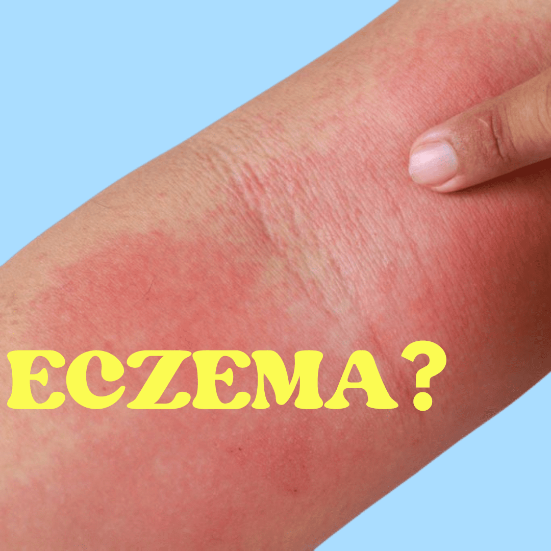 Harnessing the Healing Power of Tallow for Eczema Relief - Naturallow