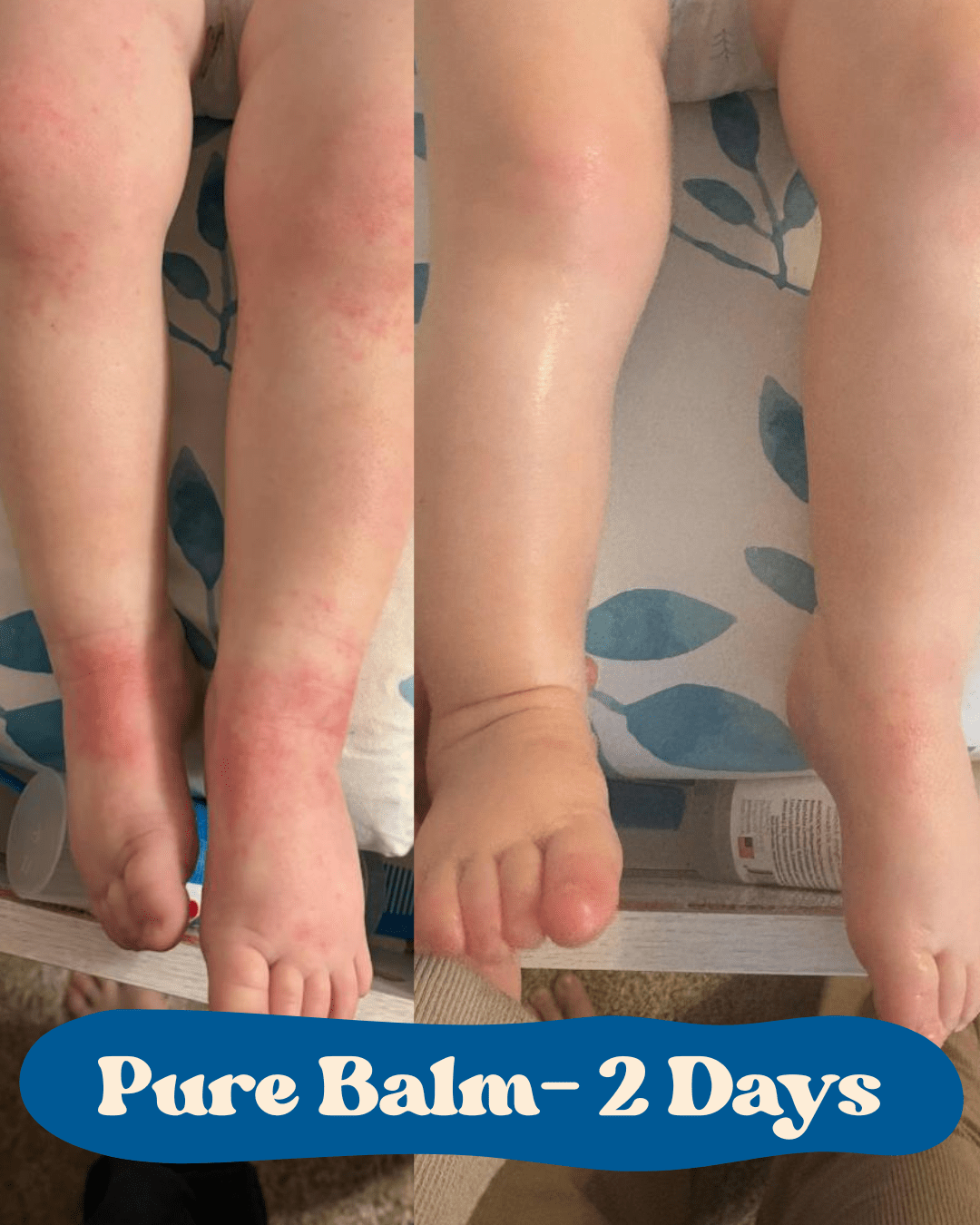 The 4 Ingredients That Calm Baby Eczema Naturally