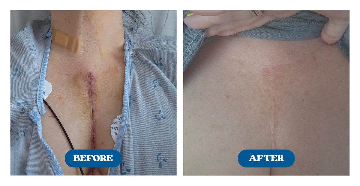Before and after shots of a chest surgery scar faded after use of Naturallow