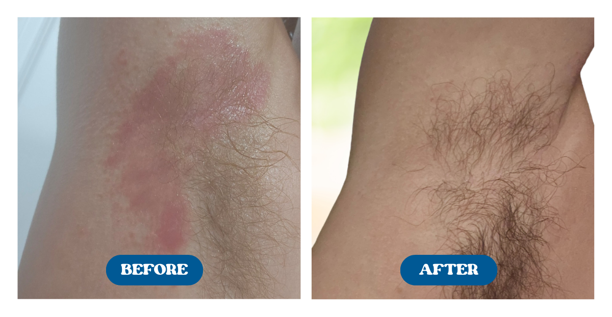 Before and after shots of a persons irritated armpit being soothed after use of Naturallow