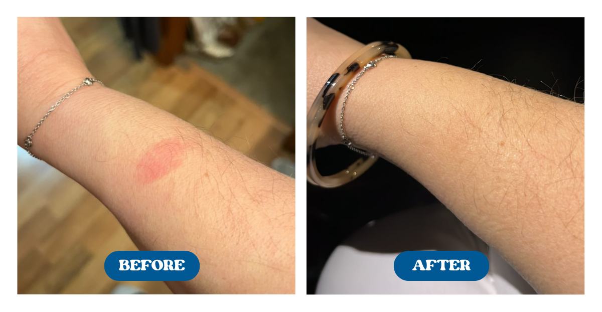 Before and after comparison of a person's arm with visible redness on the left and smooth skin on the right