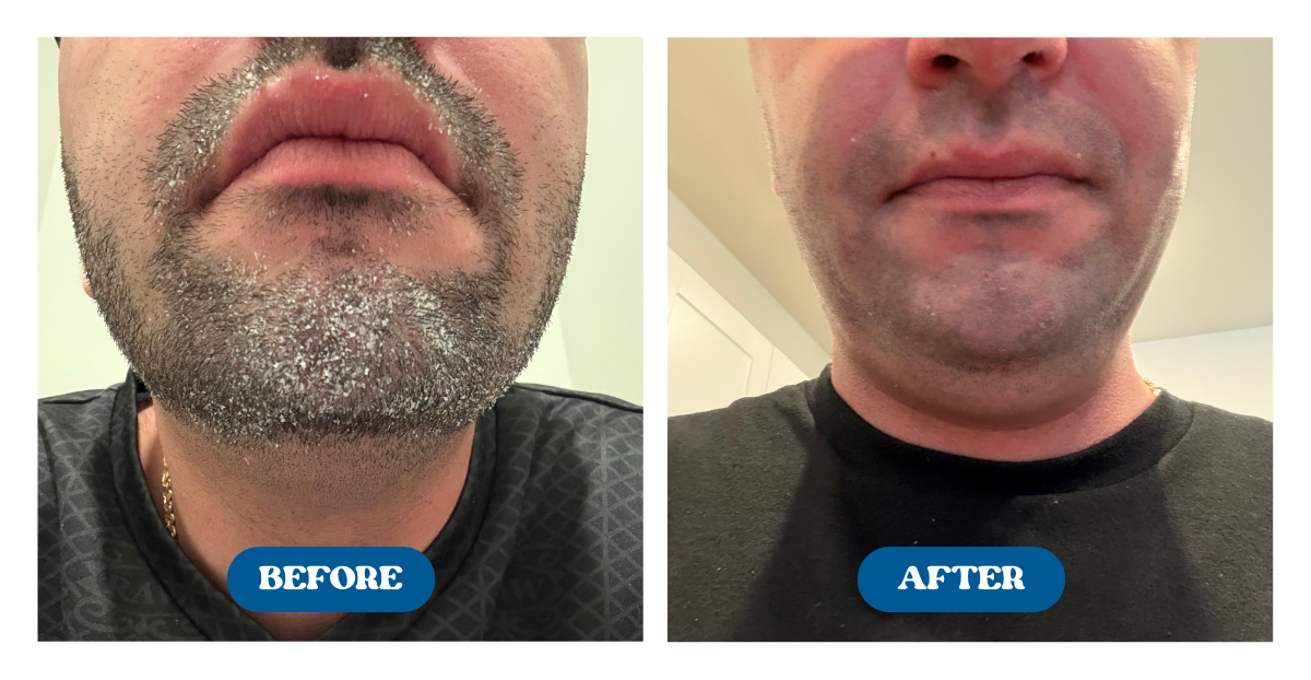 Before and after shots of dry, flaky skin being restored to new after use of Naturallow