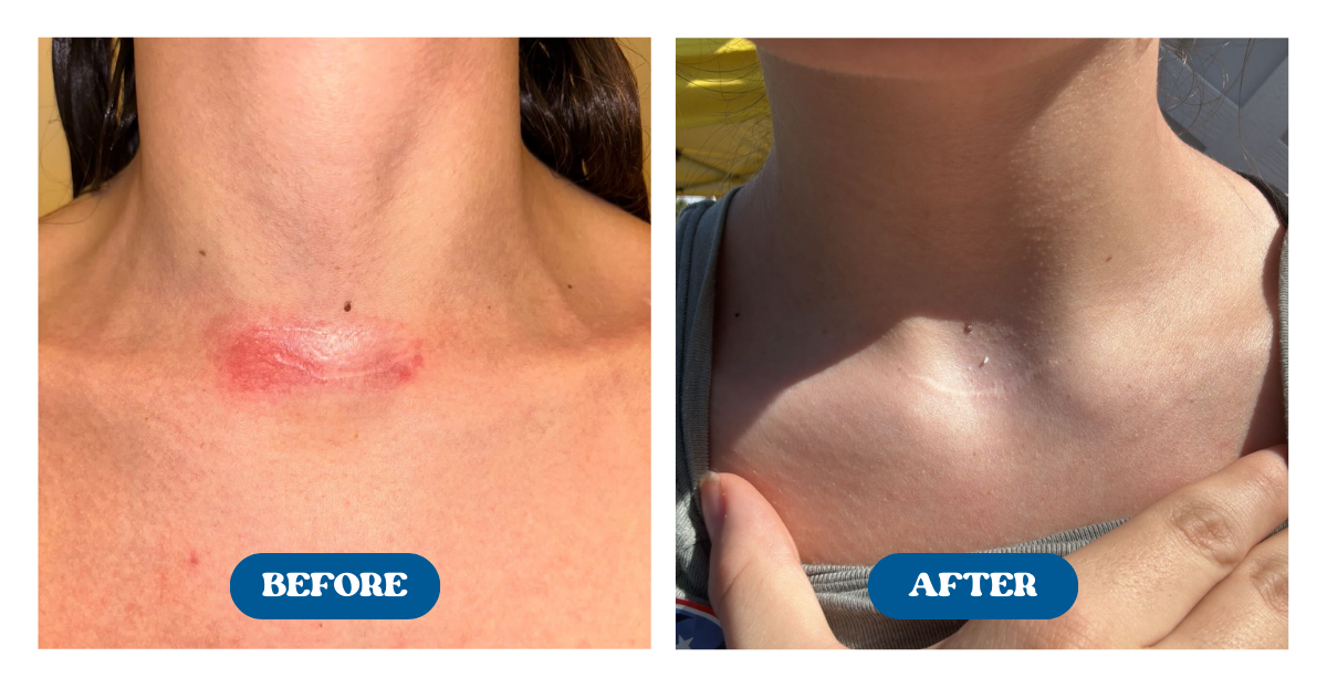 Before and after shots of a scar on the neck faded after use of Naturallow