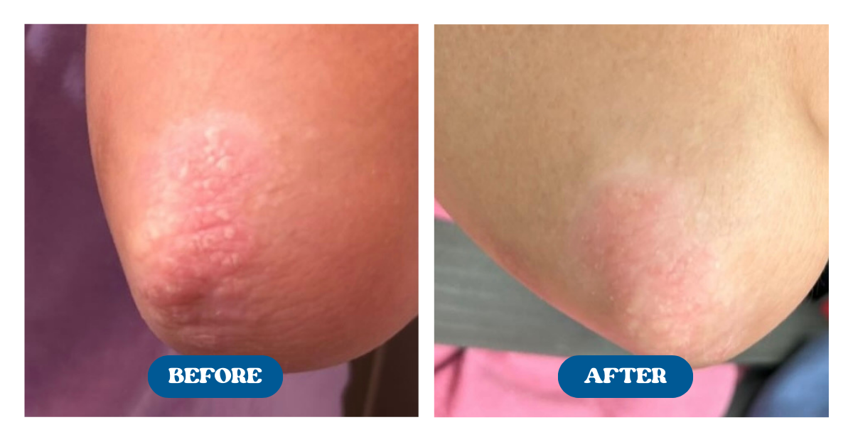 Before and after shots of a psoriasis flareup on the elbow fading after use of Naturallow