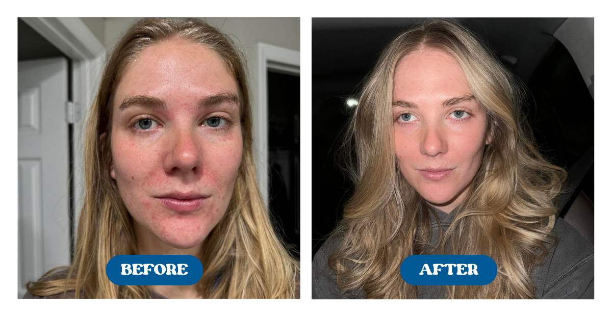 Before and after comparison of a womans face that cleared up after using Naturallow